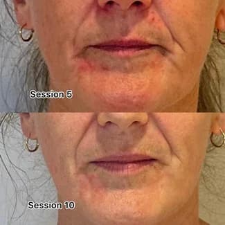 Changes in the client’s dermatitis in sessions 5 and 10.