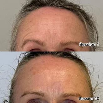 Changes in the client’s wrinkles, eyebrow symmetry.